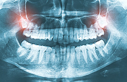X-ray image of wisdom teeth at Ortega Dental.