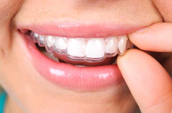 Woman using clear aligner.
