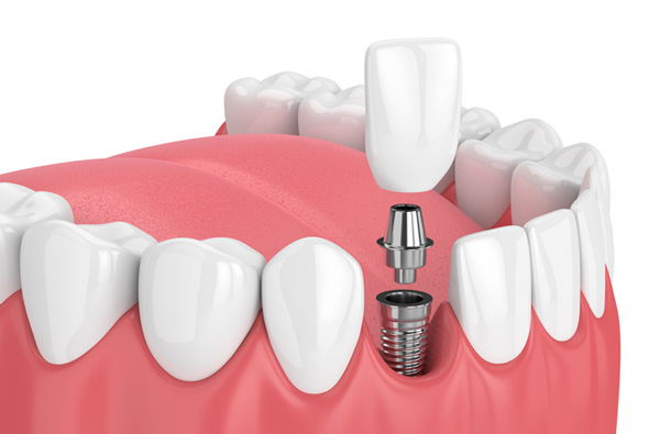 Rendering of jaw with dental implant.