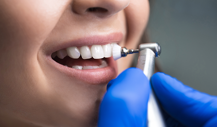 Image of a woman getting professional teeth whitening.