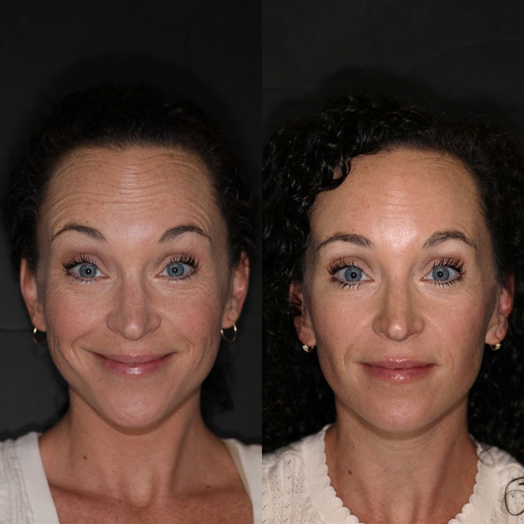 before and after of forehead botox and skincare products