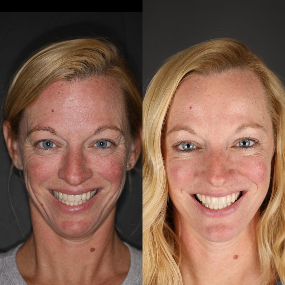 before and after crows feet botox and biofacial