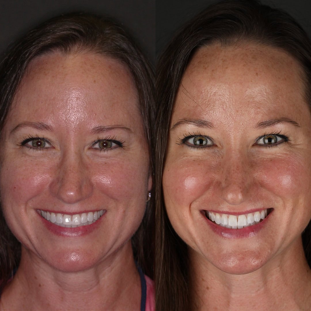 before and after of botox eyebrow lift and biofacial