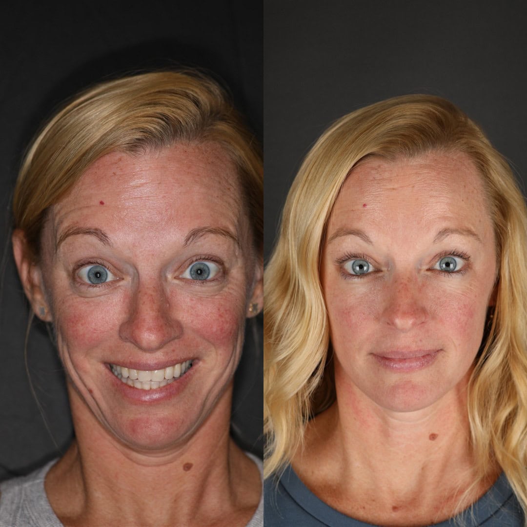 before and after of forehead botox