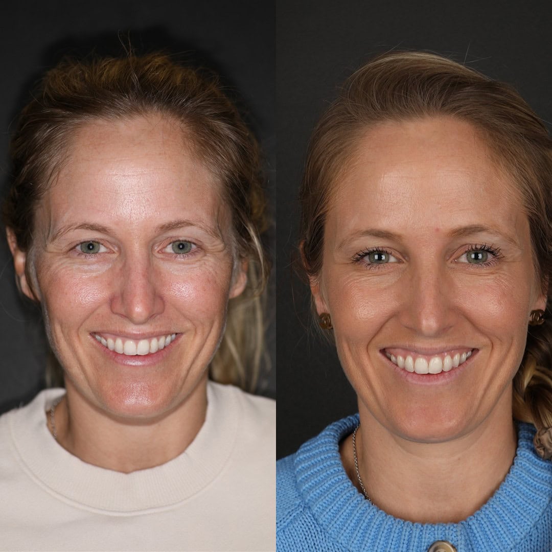 Before and after of forehead, crows feet, and 11's botox combined with skincare products
